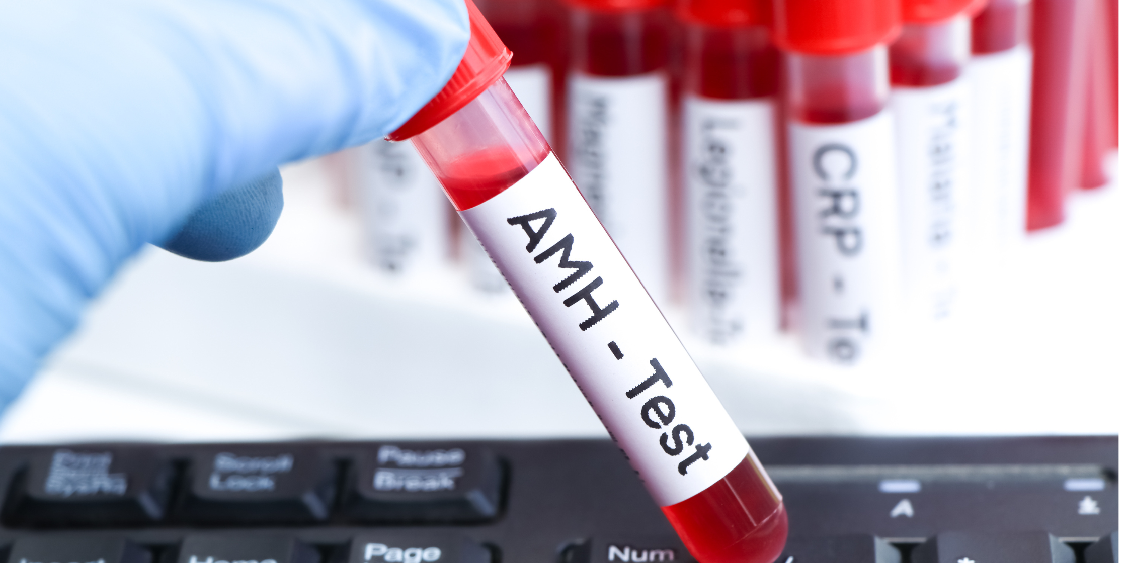 L’Hormone Antimüllérienne (AMH) : un rôle clé pour la fertilité
