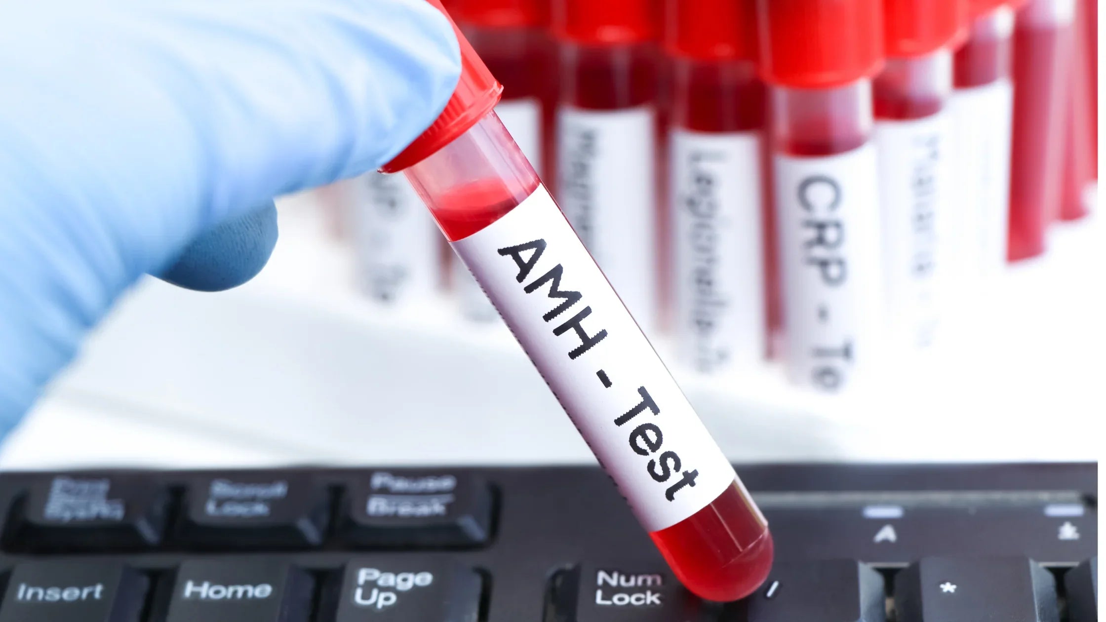 L’Hormone Antimüllérienne (AMH) : un rôle clé pour la fertilité