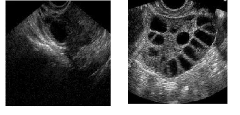 AMH élevée et SOPK 