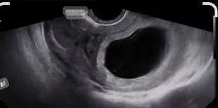 Échographie de début de grossesse montrant un sac gestationnel vide (œuf clair)