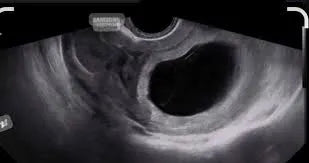Échographie de début de grossesse montrant un sac gestationnel vide (œuf clair)